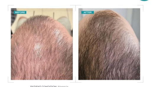 Alopecia treatment — before and after hair restoration