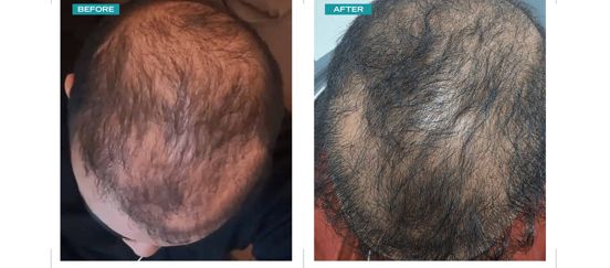 Crown hair loss treatment — before and after
