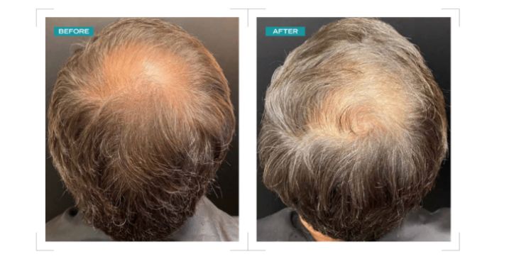 Crown thinning treatment — before and after Potenza Fusion