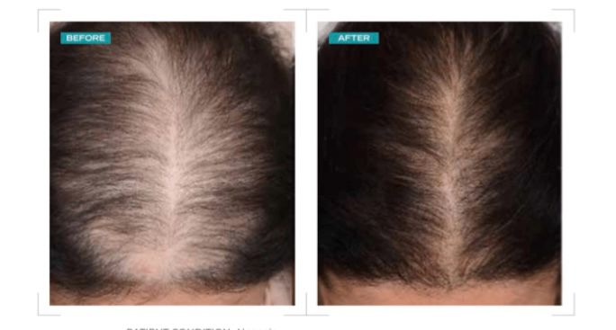 Female hair loss treatment before and after — crown area thickening with Exosome and Potenza Fusion tip