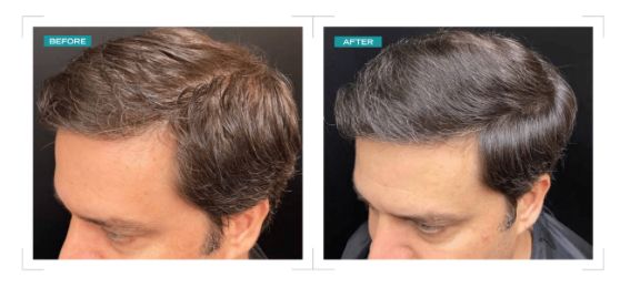 Hair loss treatment before and after — frontal hairline regrowth with Exosome and Potenza Fusion tip