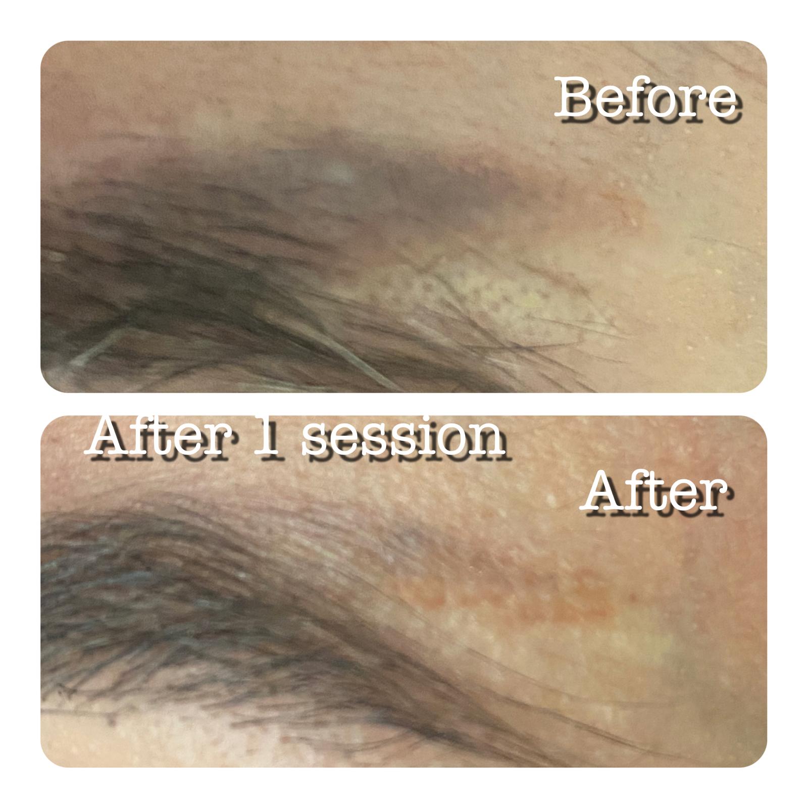 Pigmentation before and after 1 PicoSure session — real client result