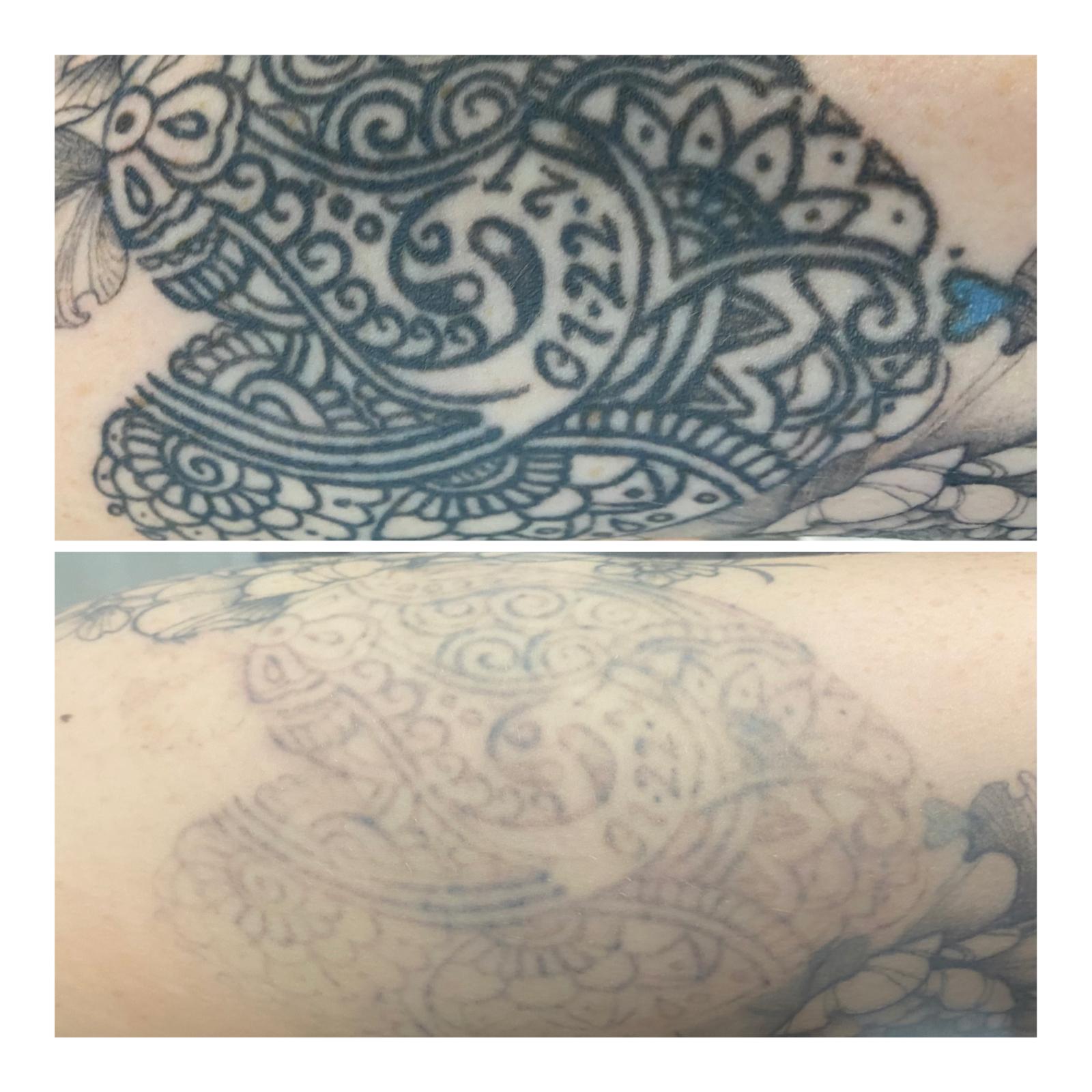 Mandala tattoo before and after PicoSure fading — ready for cover-up