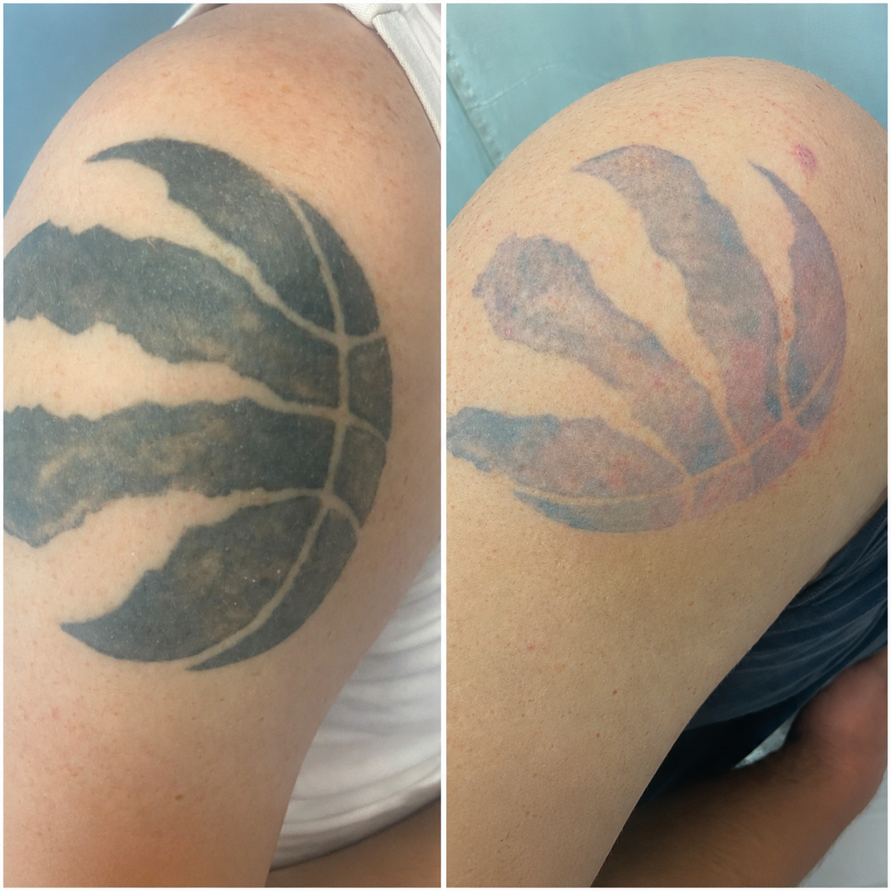 Raptors basketball tattoo before and after PicoSure laser removal — significant fading on shoulder