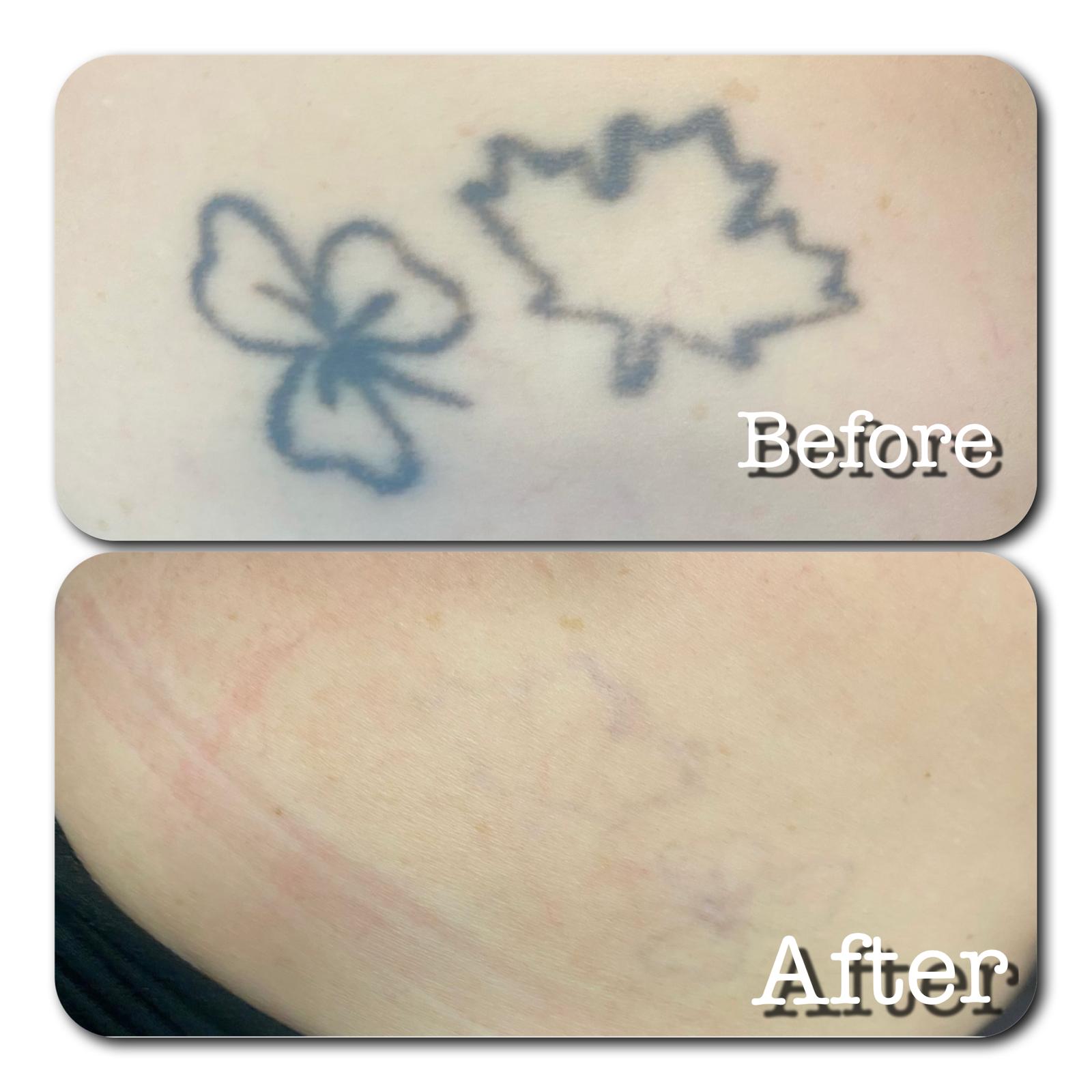 Shamrock and maple leaf tattoo fully removed by PicoSure laser — before and after