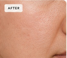 After texture treatment