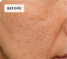 Before texture treatment